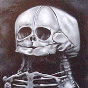 Painting of Conjoined Twins